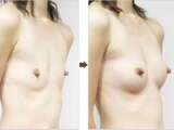 I collected plastic surgery images of breast surgery before and after breast augmentation www This is surprising!!